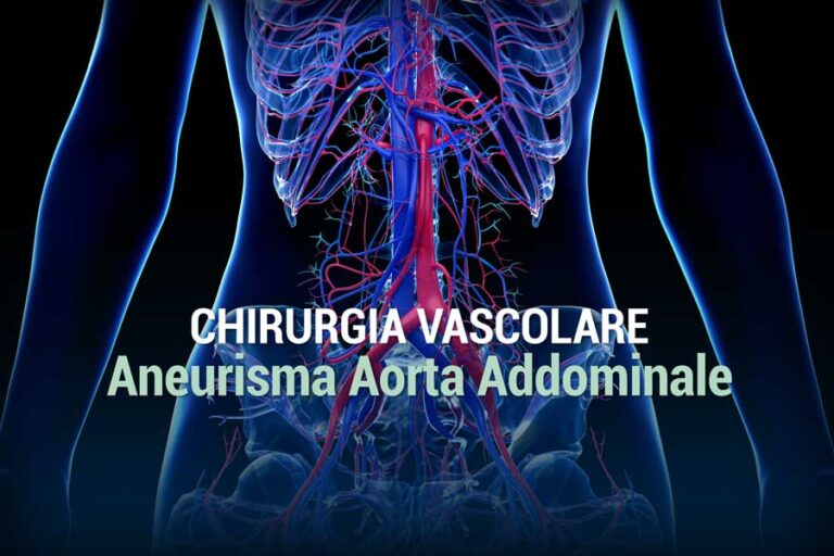 Aneurisma Aorta Addominale