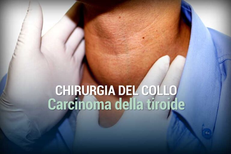 Carcinoma della tiroide