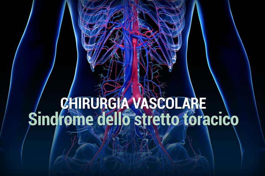 Sindrome dello stretto toracico