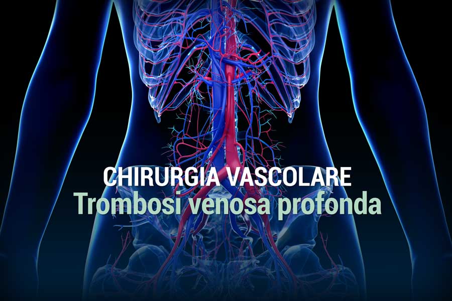 Trombosi venosa profonda